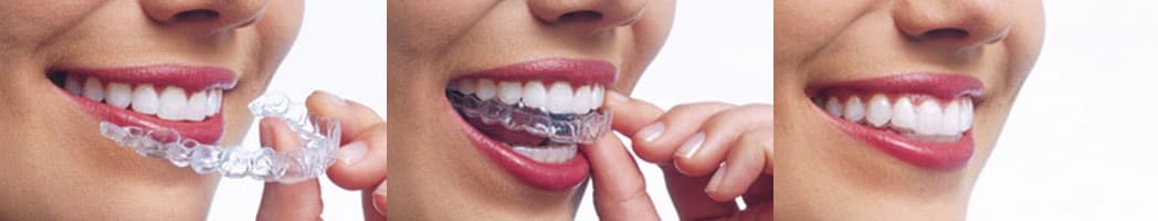 Herausnehmbare Aligner-Schiene in der Hand