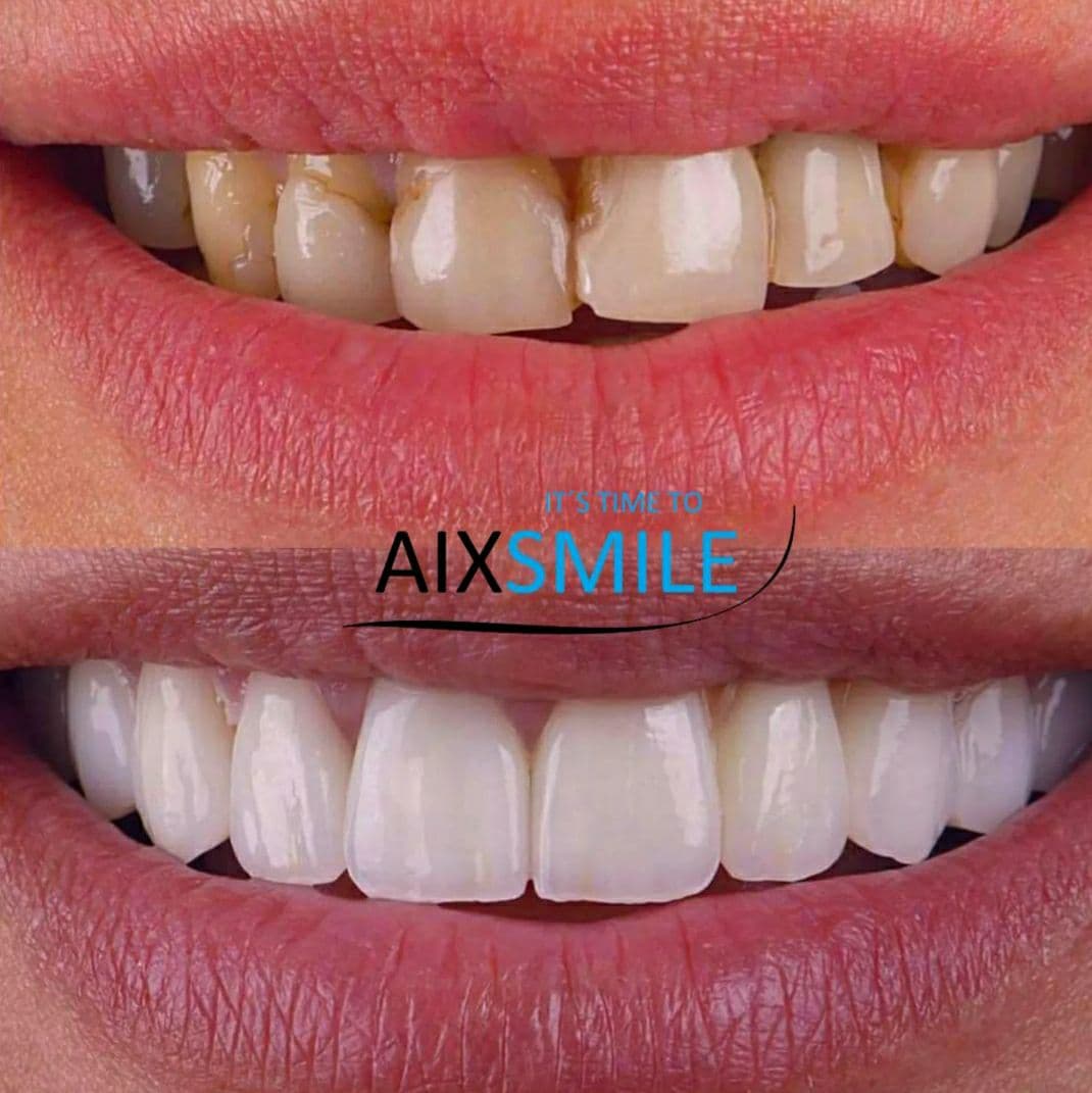 Zähne vor und nach der Versorgung mit Veneers – Fall 2
