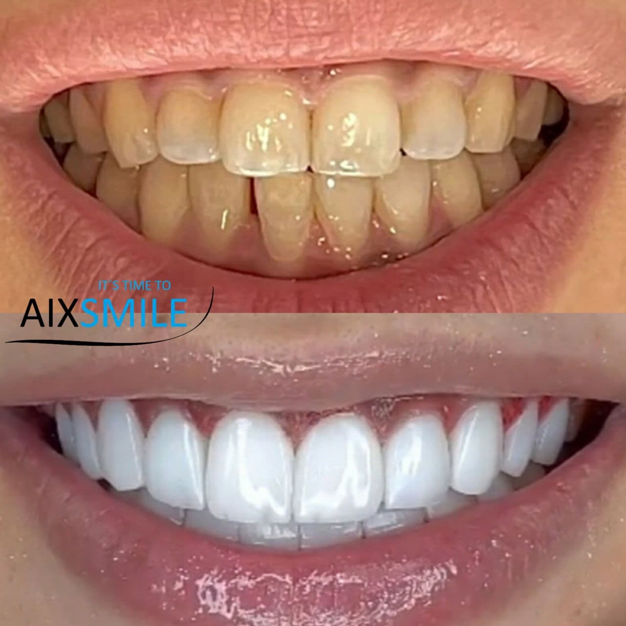Zähne vor und nach der Versorgung mit Veneers – Fall 3
