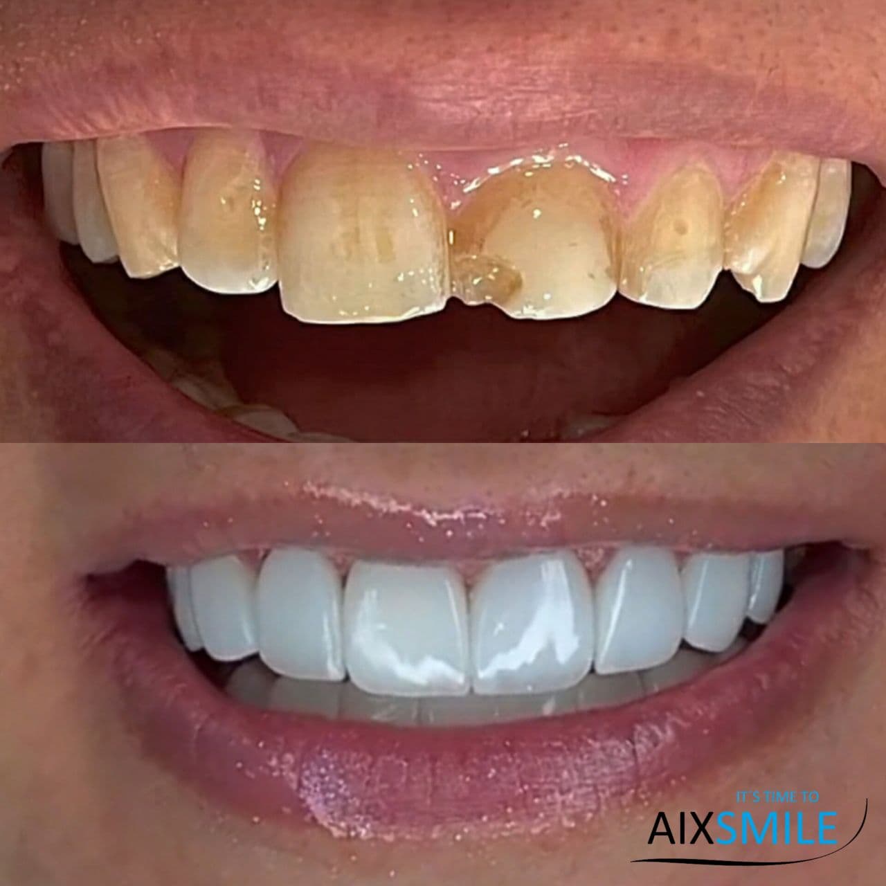 Zähne vor und nach der Versorgung mit Veneers – Fall 4