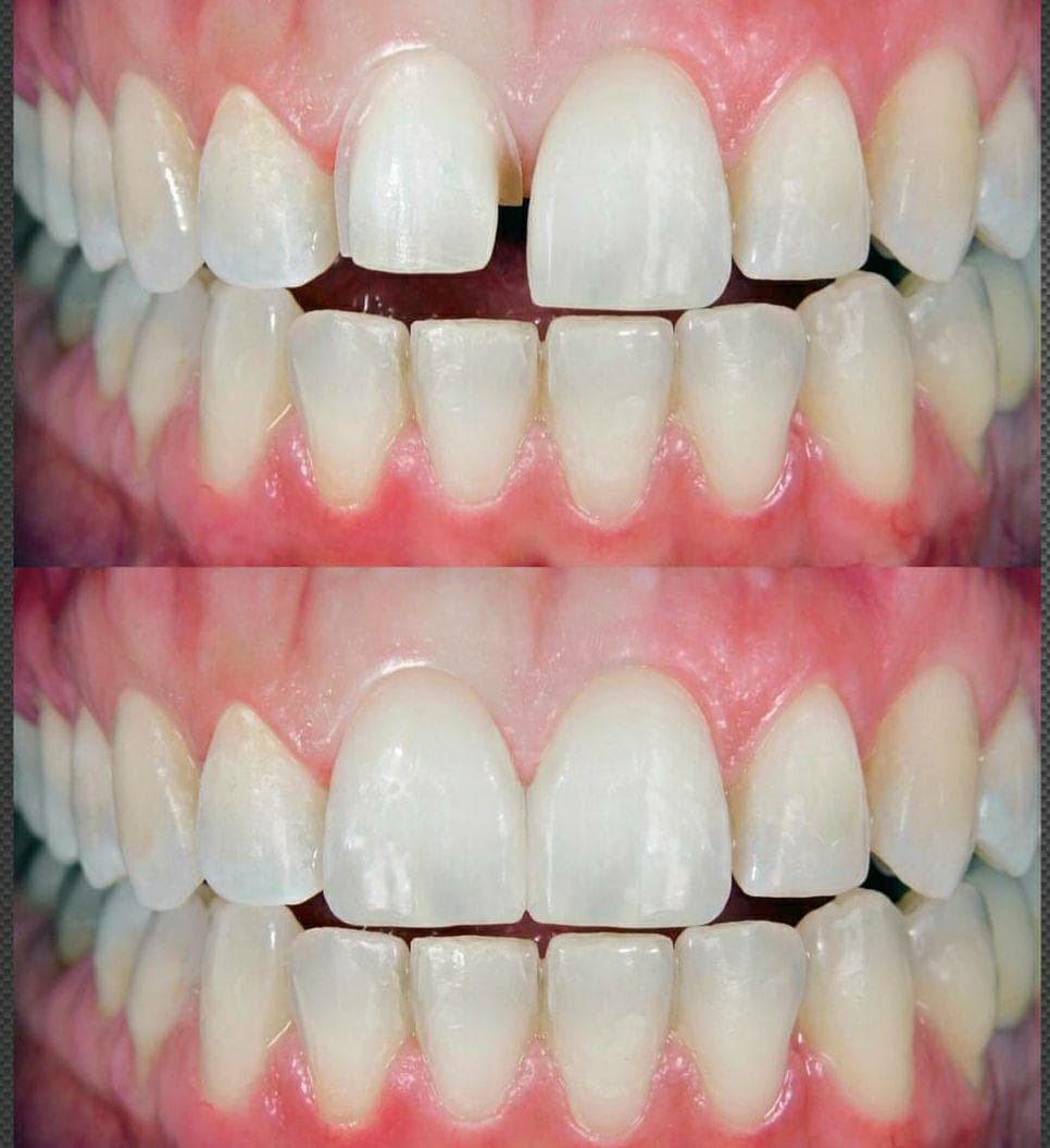 Zähne vor und nach der Versorgung mit Veneers – Fall 5