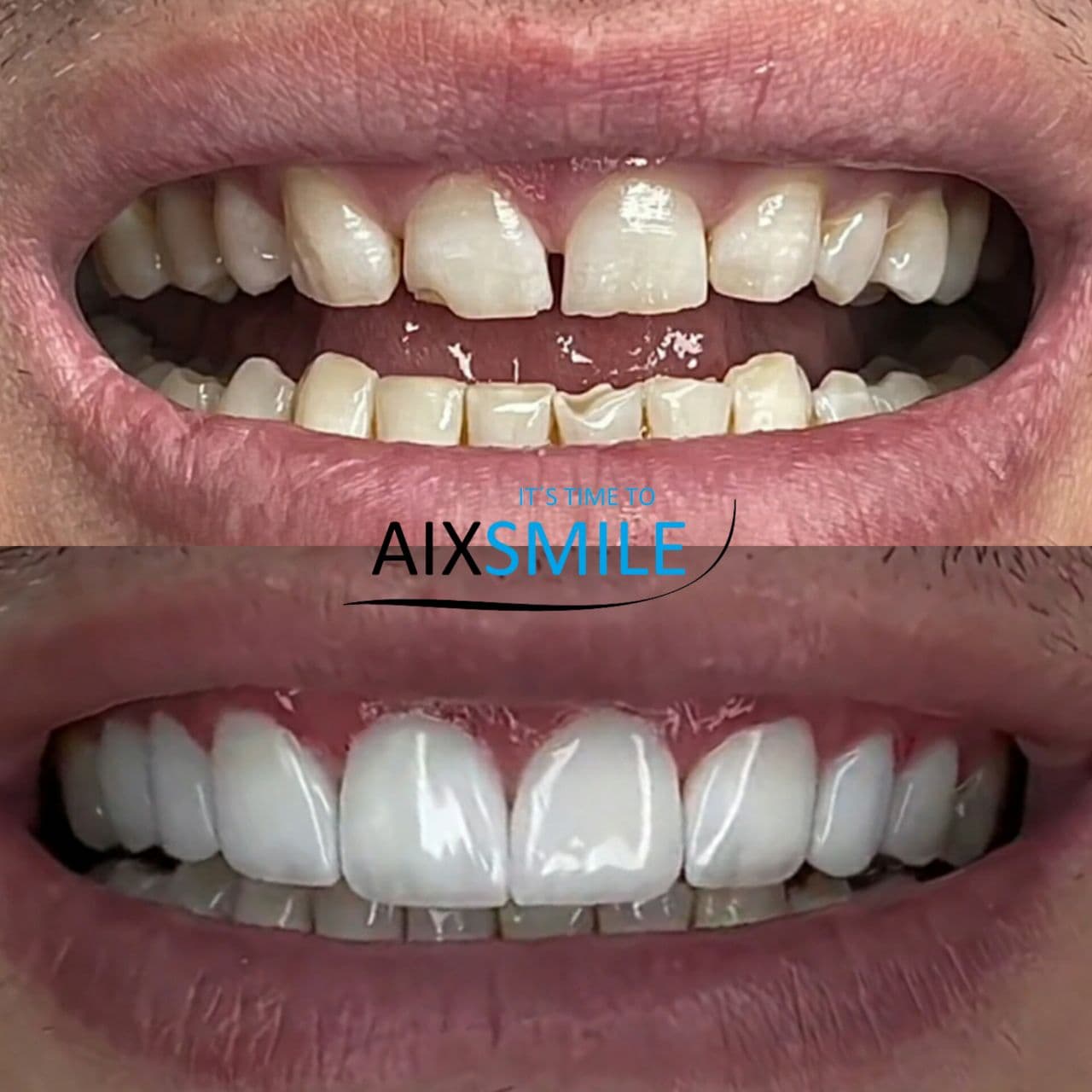 Zähne vor und nach der Versorgung mit Veneers – Fall 1