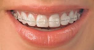 Keramikbrackets