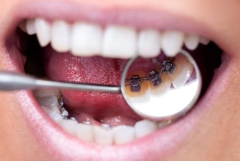 Linguale Brackets