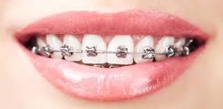 Festsitzende Zahnspange mit Metallbrackets