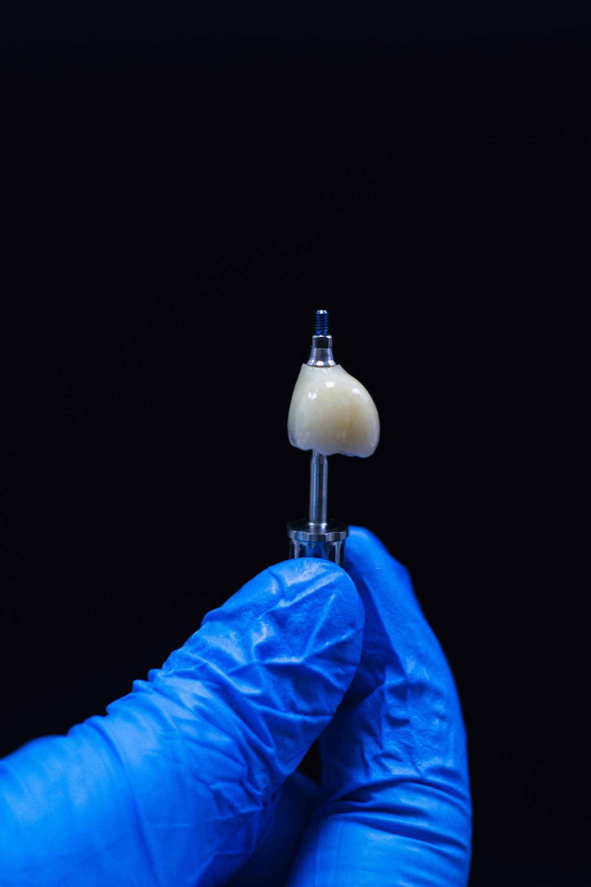 Festsitzender Zahnersatz auf dem Implantat – Nahaufnahme (Beispielbild)