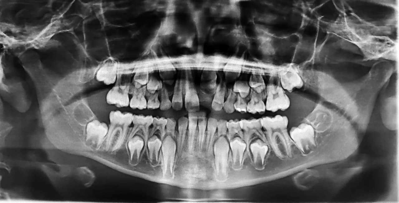 Röntgenaufnahme zur Diagnose des Zahns und der Wurzeln (Beispielbild)