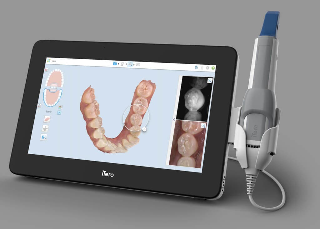 Digitaler 3D-Scan der Zähne mit dem Intraoralscanner (Beispielbild)