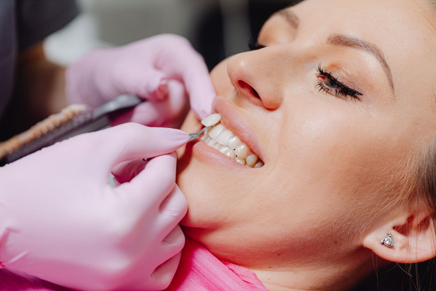 Beratung und Farbabstimmung der Veneers (Beispielbild)